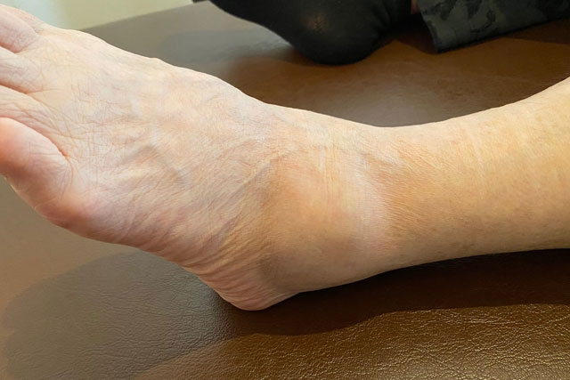 変形性足関節症81歳女性