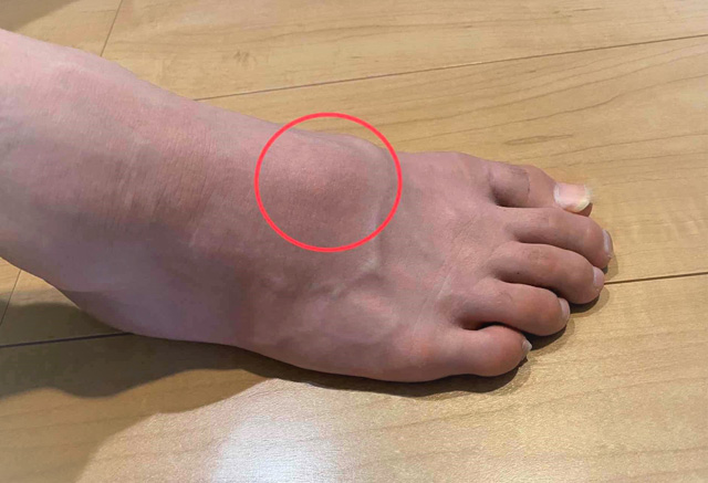 足の甲の痛み10歳男性